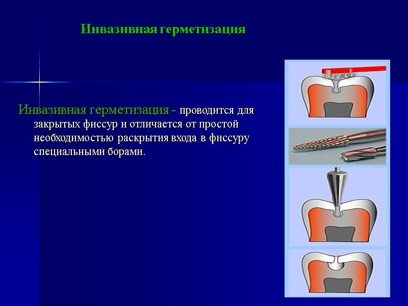 Инвазивная герметизация - проводится для закрытых фиссур и отличается от простой необходимостью раскрытия входа